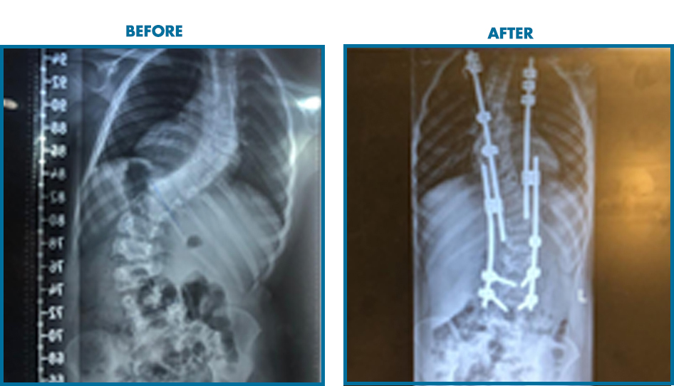 Case 2: 9 years old girl with severe multilevel deformities in her back